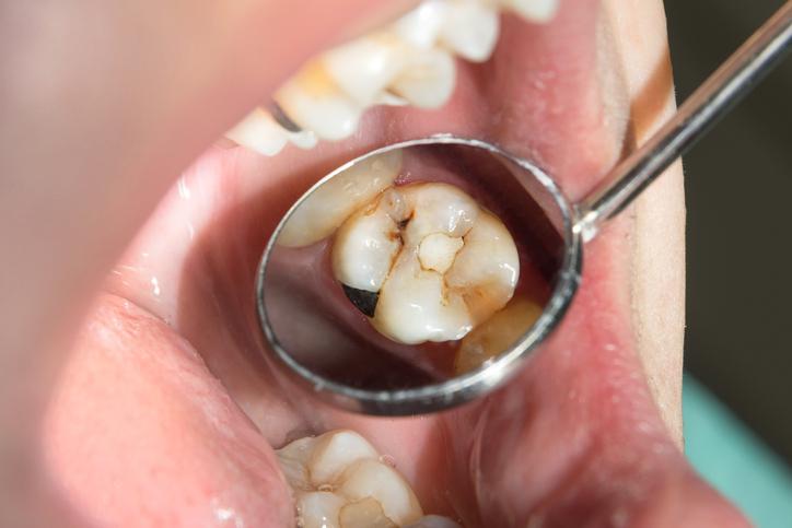 Diş çürükleri çocuklar ve yetişkinlerde kalp hastalıklarını tetikleyebiliyor