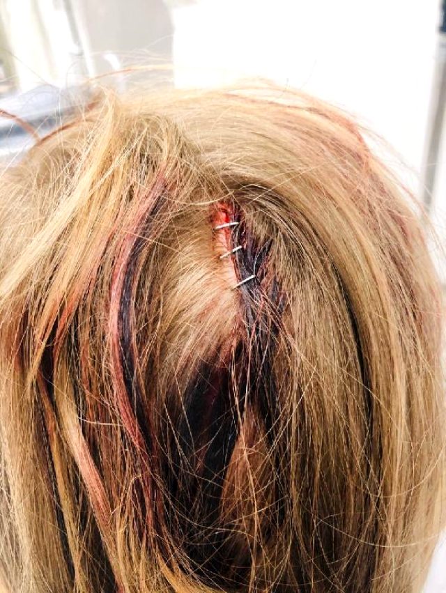 Muştalı saldırıya uğrayan 5 yaşındaki çocuğun kafası delindi