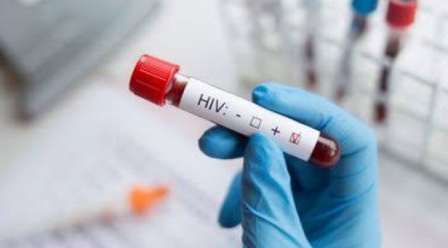 Hiv Testi Nedir?